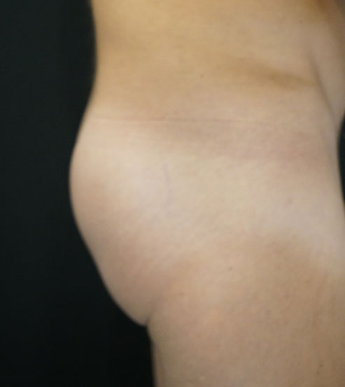 Buttock Augmentation With Implants Before and After | Kotis