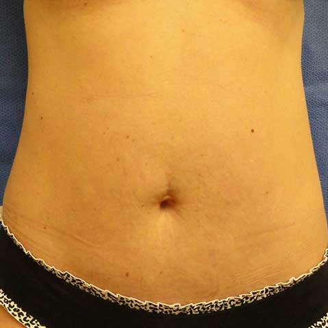 Mini Tummy Tuck Before and After | Kotis