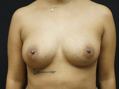 Fat Transfer Breast Augmentation results