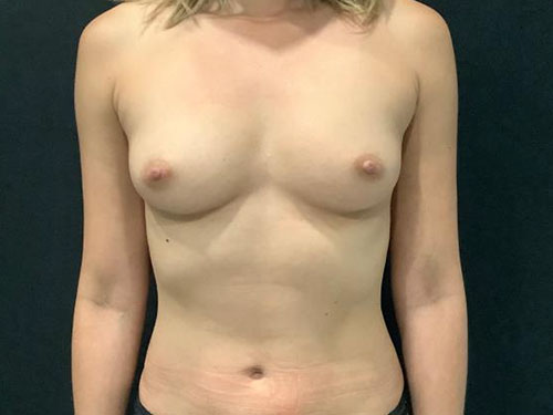 Fat Transfer Breast Augmentation results