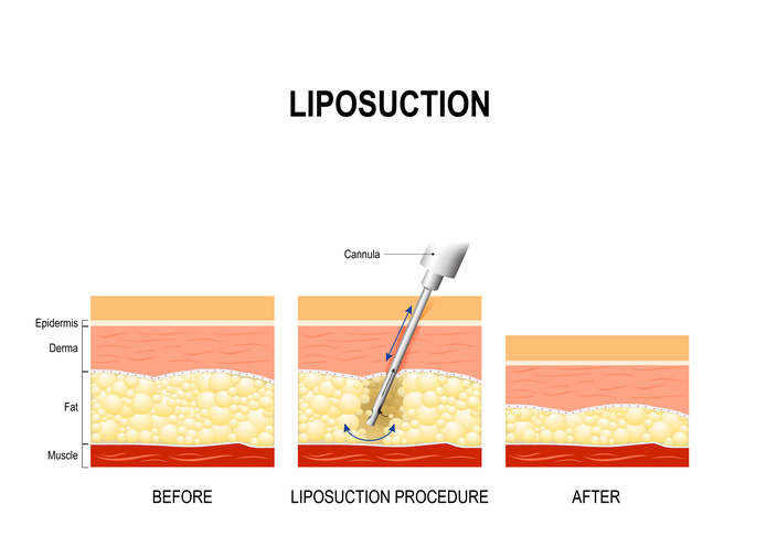 Diagram of how liposuction works