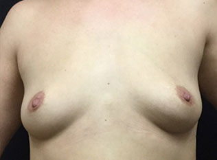Breast Implants Chicago