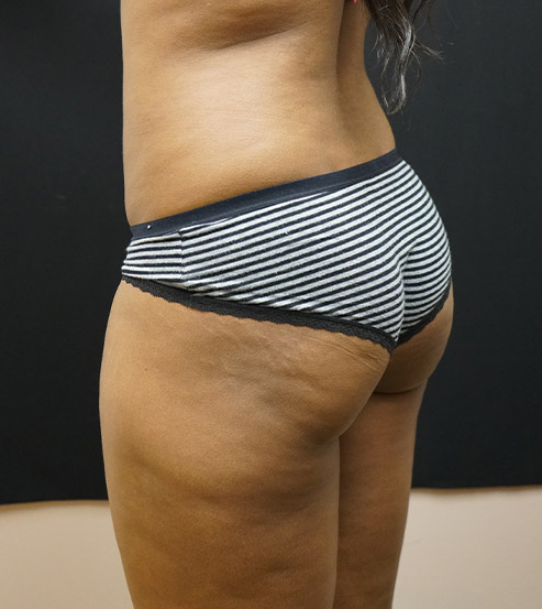 Brazilian Butt Lift Before and After | Kotis