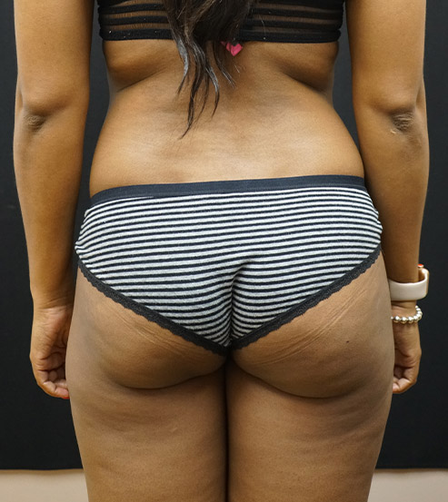 Brazilian Butt Lift Before and After | Kotis