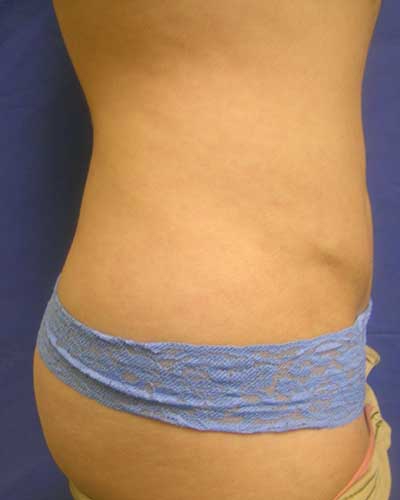 Liposuction Before and After | Kotis