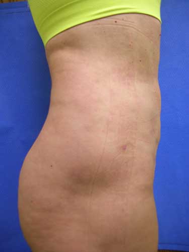 Liposuction Before and After | Kotis