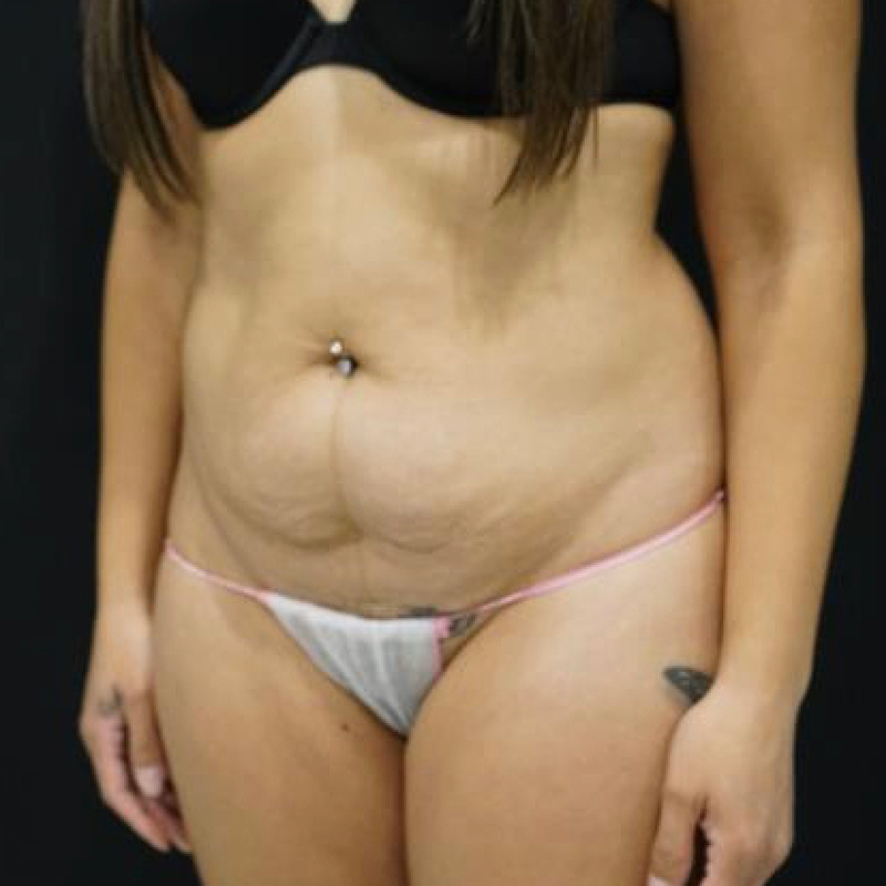Mini Tummy Tuck Before and After | Kotis