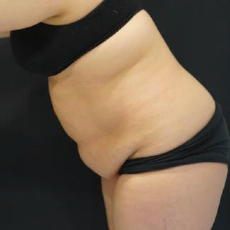 Tummy Tuck Before and After | Kotis