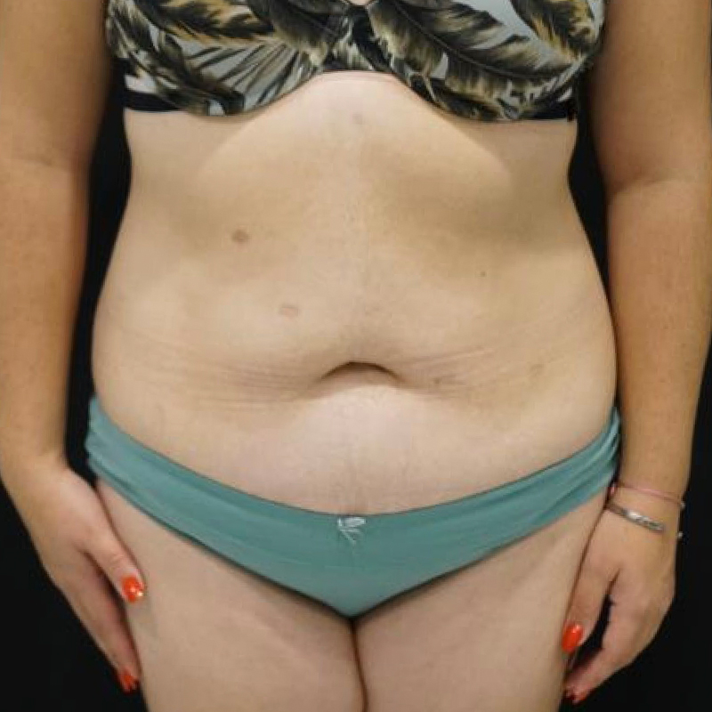 Tummy Tuck Before and After | Kotis