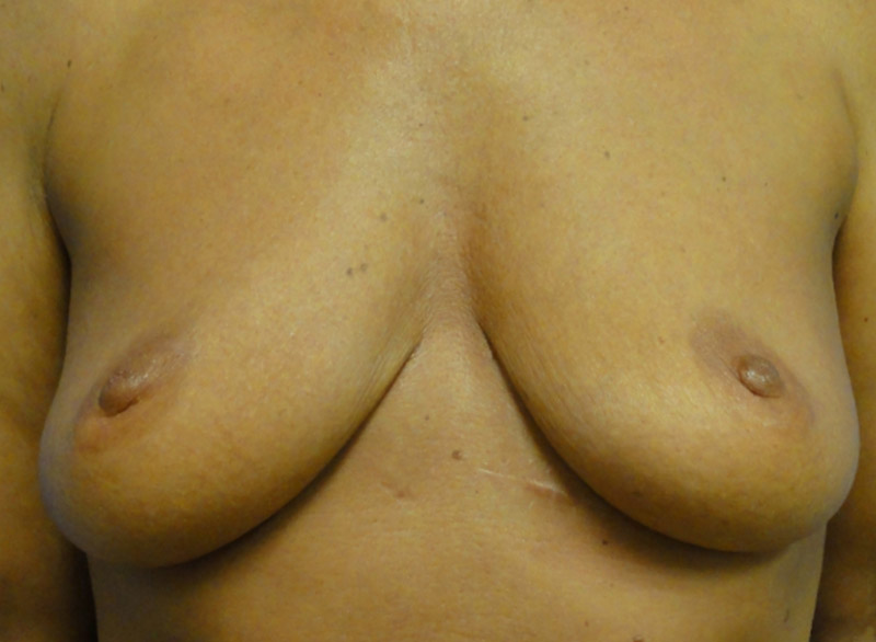 Breast Augmentation And Lift Before and After | Kotis