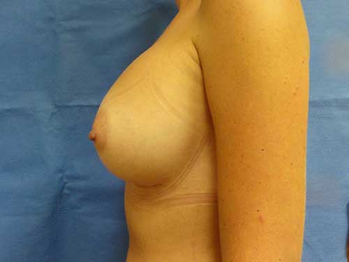 Breast Augmentation Before and After | Kotis
