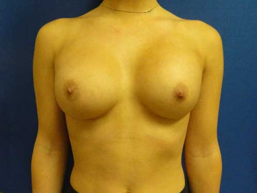 Breast Augmentation Before and After | Kotis