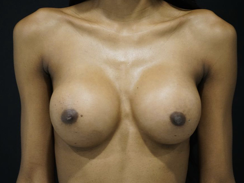 Breast Augmentation Chicago