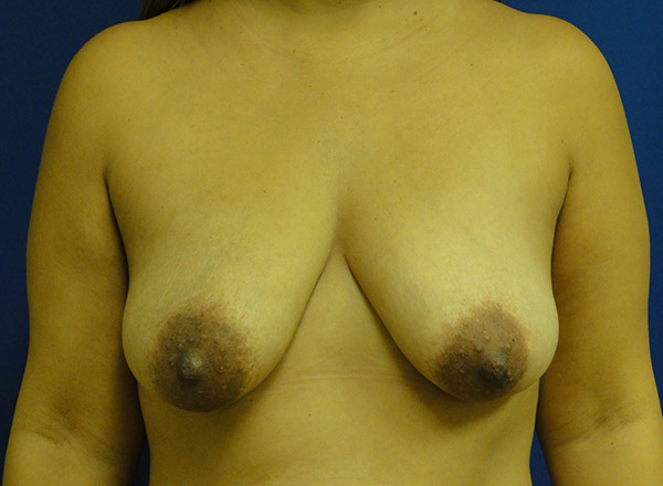 Breast Lift Before and After | Kotis