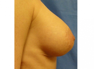 Breast Lift Before and After | Kotis