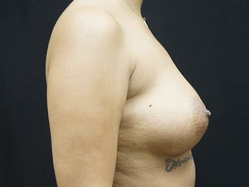 Fat Transfer To Breast Before and After | Kotis
