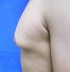 Gynecomastia Before and After | Kotis
