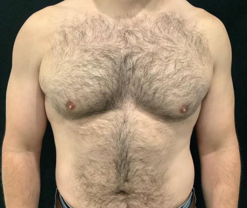 Gynecomastia Before and After | Kotis