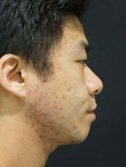 Chin Augmentation Before and After | Kotis