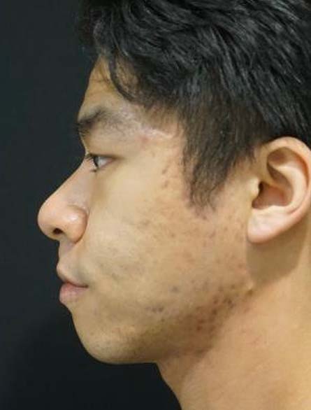 Chin Augmentation Before and After | Kotis