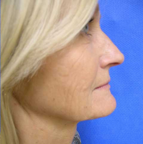 Facelift Before and After | Kotis