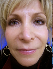 Facelift Before and After | Kotis