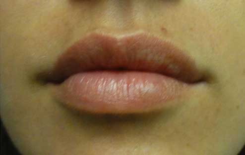 Lip Augmentation Before and After | Kotis