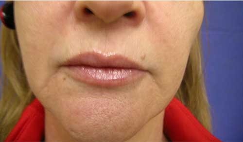 Lip Augmentation Before and After | Kotis