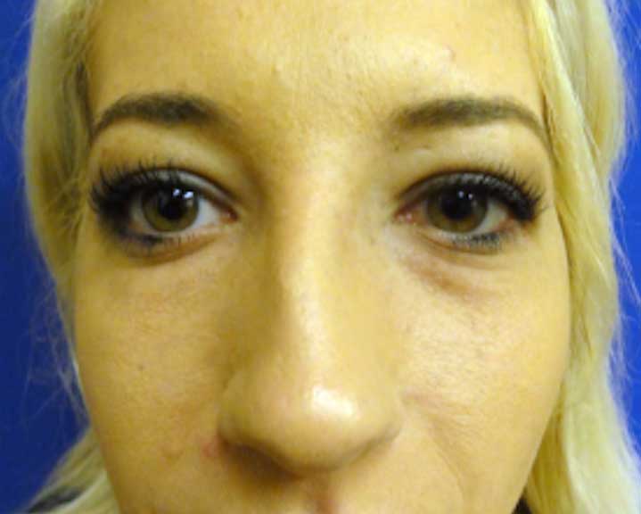 Lower Eyelid Before and After | Kotis