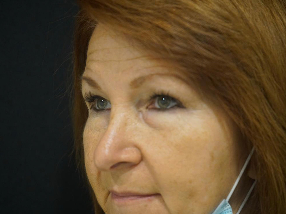 Lower Eyelid Before and After | Kotis