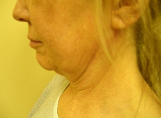 Neck Lift Before and After | Kotis
