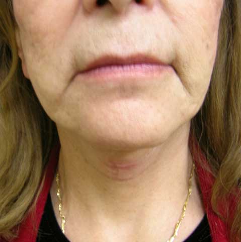 Neck Lift Before and After | Kotis