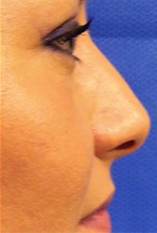 Rhinoplasty Before and After | Kotis