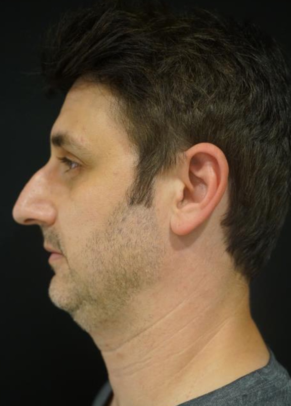 Rhinoplasty Before and After | Kotis