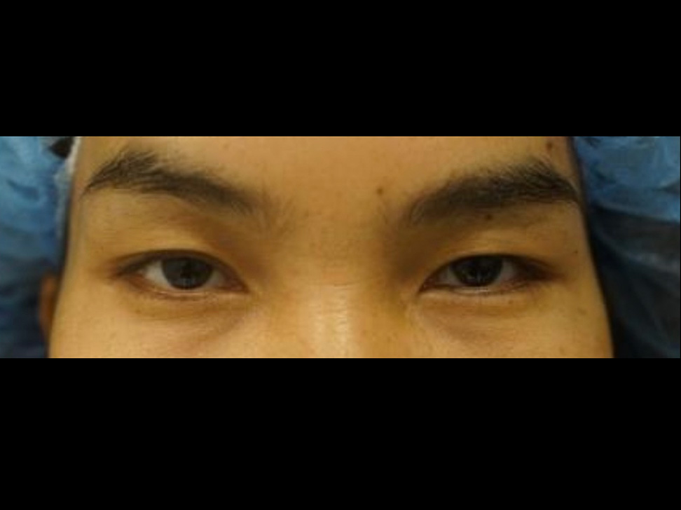 Upper Eyelid Before and After | Kotis