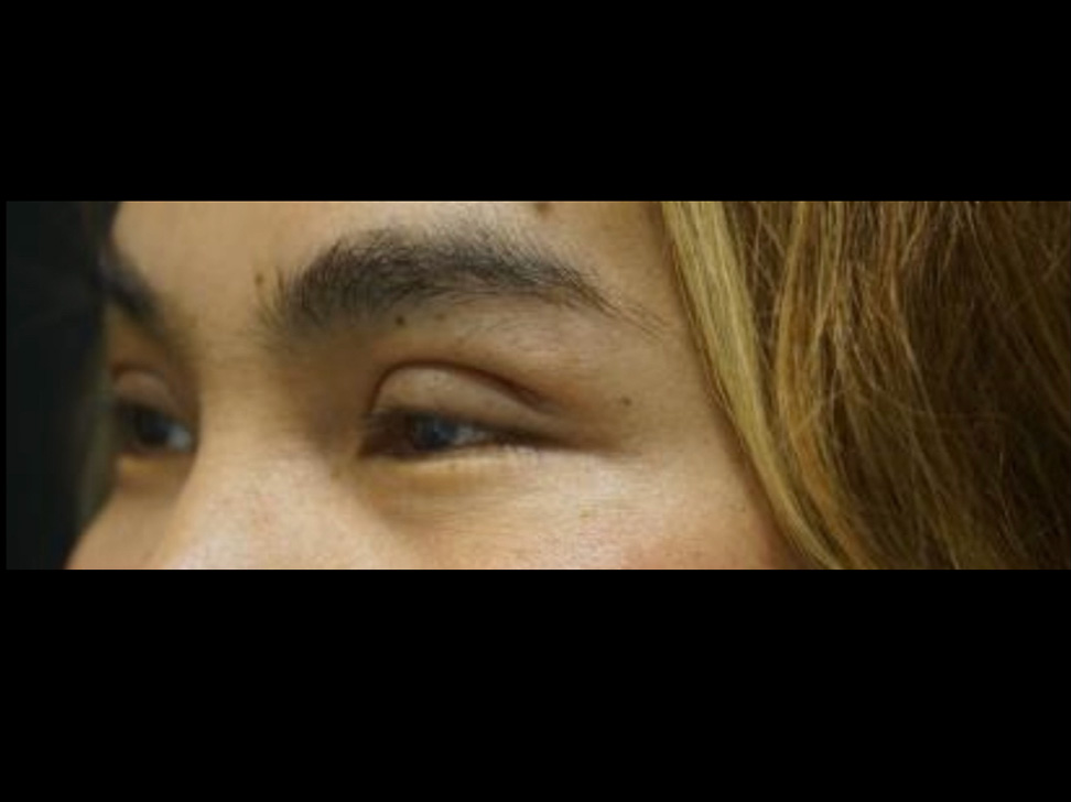 Upper Eyelid Before and After | Kotis