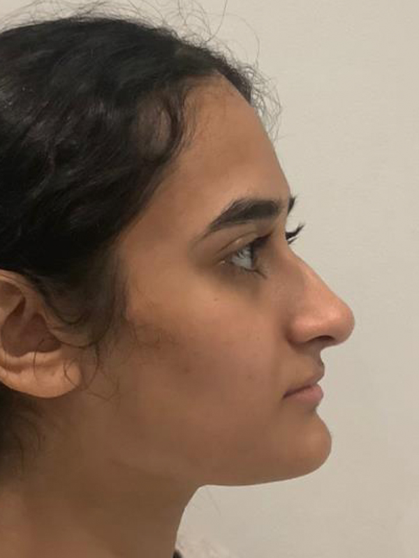 Liquid Rhinoplasty Before and After | Kotis