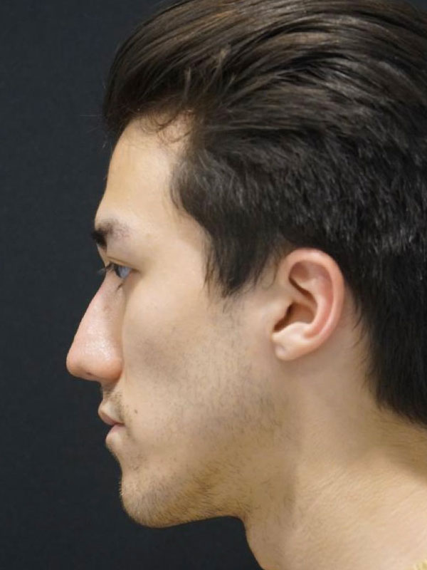 Liquid Rhinoplasty Before and After | Kotis