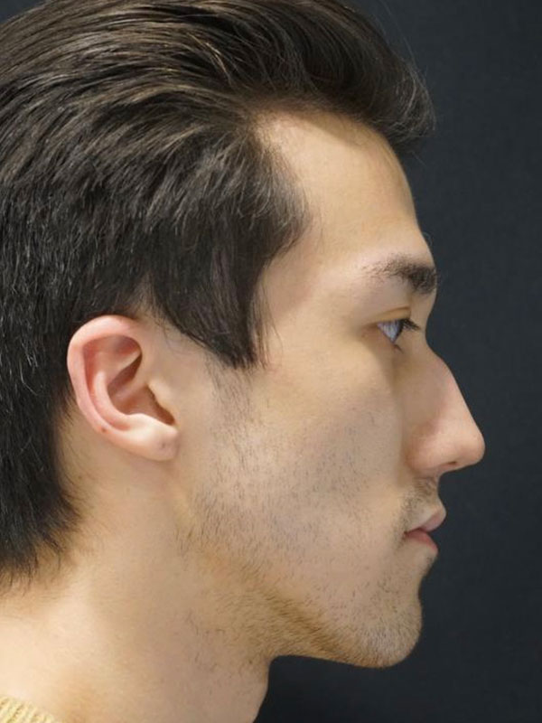 Liquid Rhinoplasty Before and After | Kotis