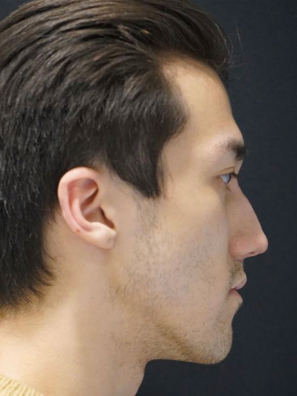 Liquid Rhinoplasty Before and After | Kotis