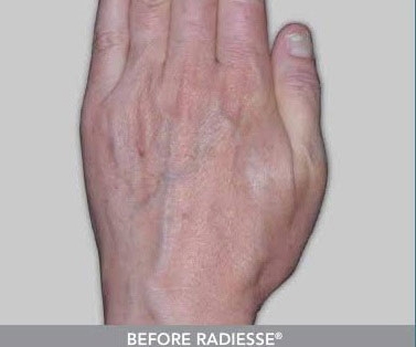 Radiesse Before and After | Kotis